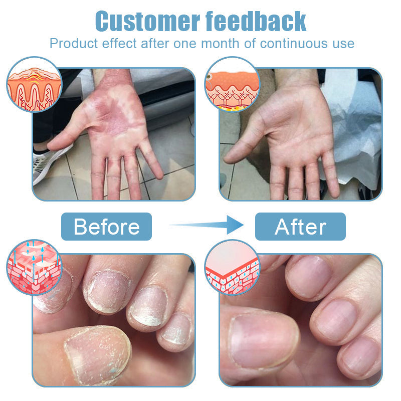 🌞Bee Poison & Ocean Natural Eczema Psoriasis Relief Cream (For all skin conditions)