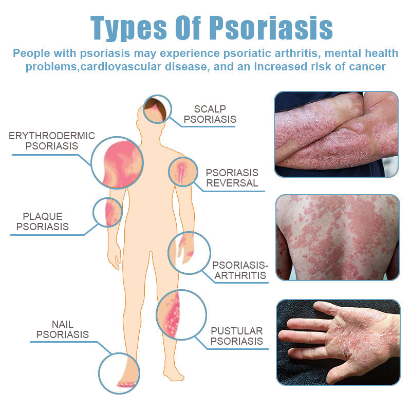 🌞Bee Poison & Ocean Natural Eczema Psoriasis Relief Cream (For all skin conditions)