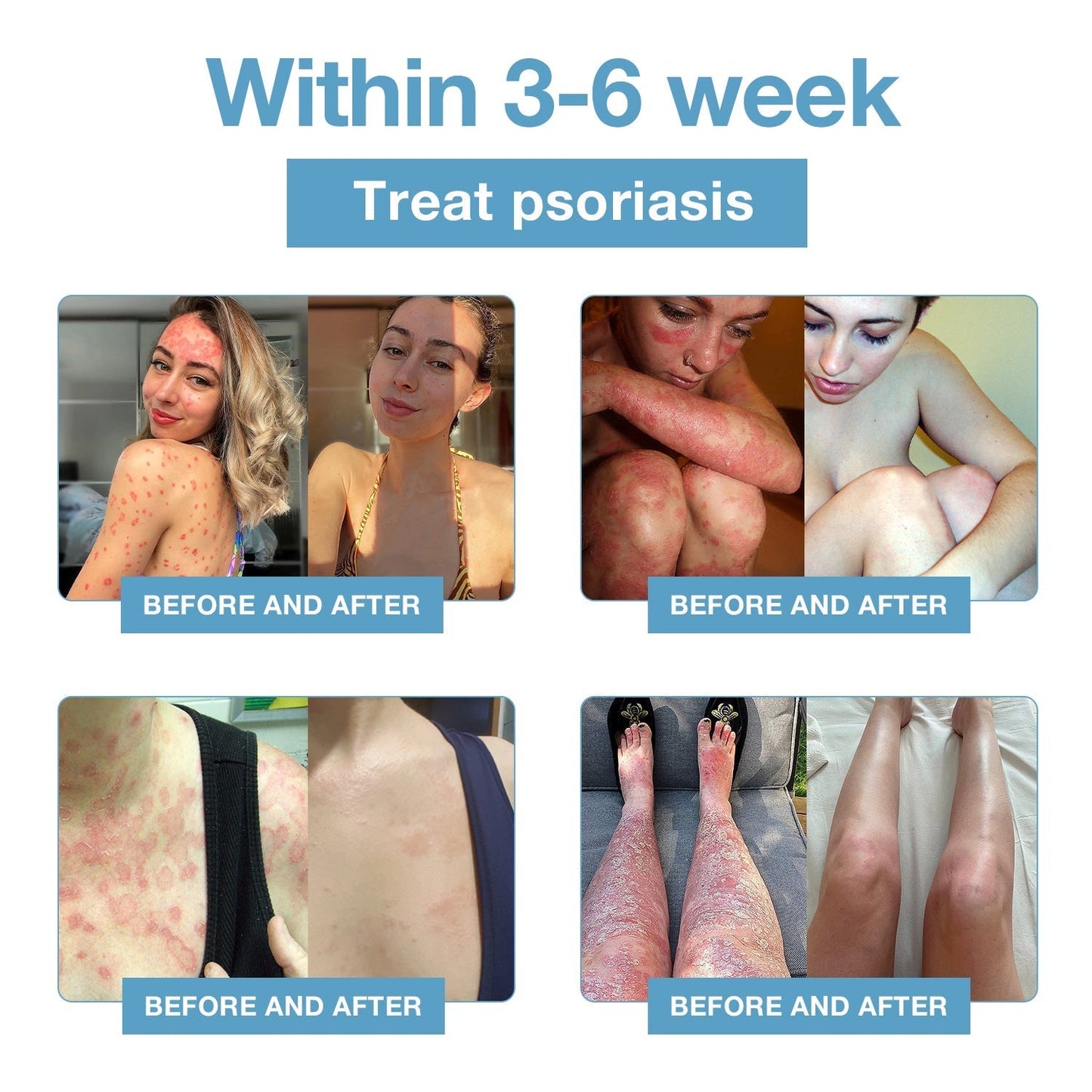🌞Bee Poison & Ocean Natural Eczema Psoriasis Relief Cream (For all skin conditions)
