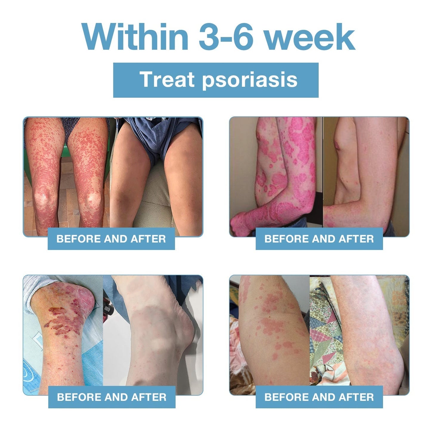 🌞Bee Poison & Ocean Natural Eczema Psoriasis Relief Cream (For all skin conditions)