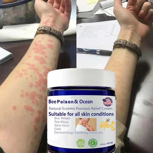 🌞Bee Poison & Ocean Natural Eczema Psoriasis Relief Cream (For all skin conditions)