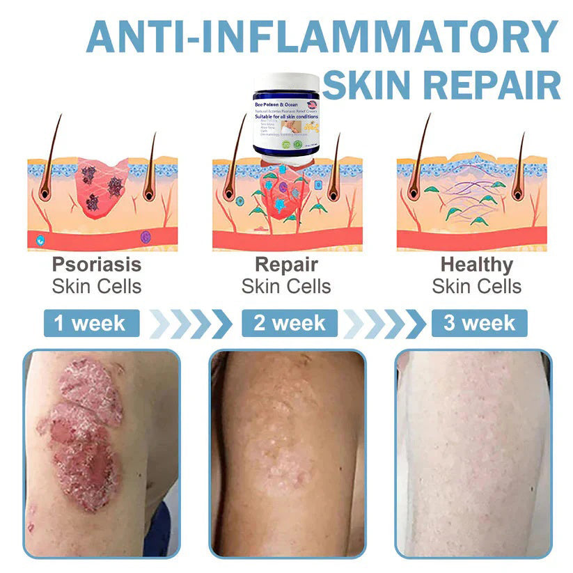 🌞Bee Poison & Ocean Natural Eczema Psoriasis Relief Cream (For all skin conditions)