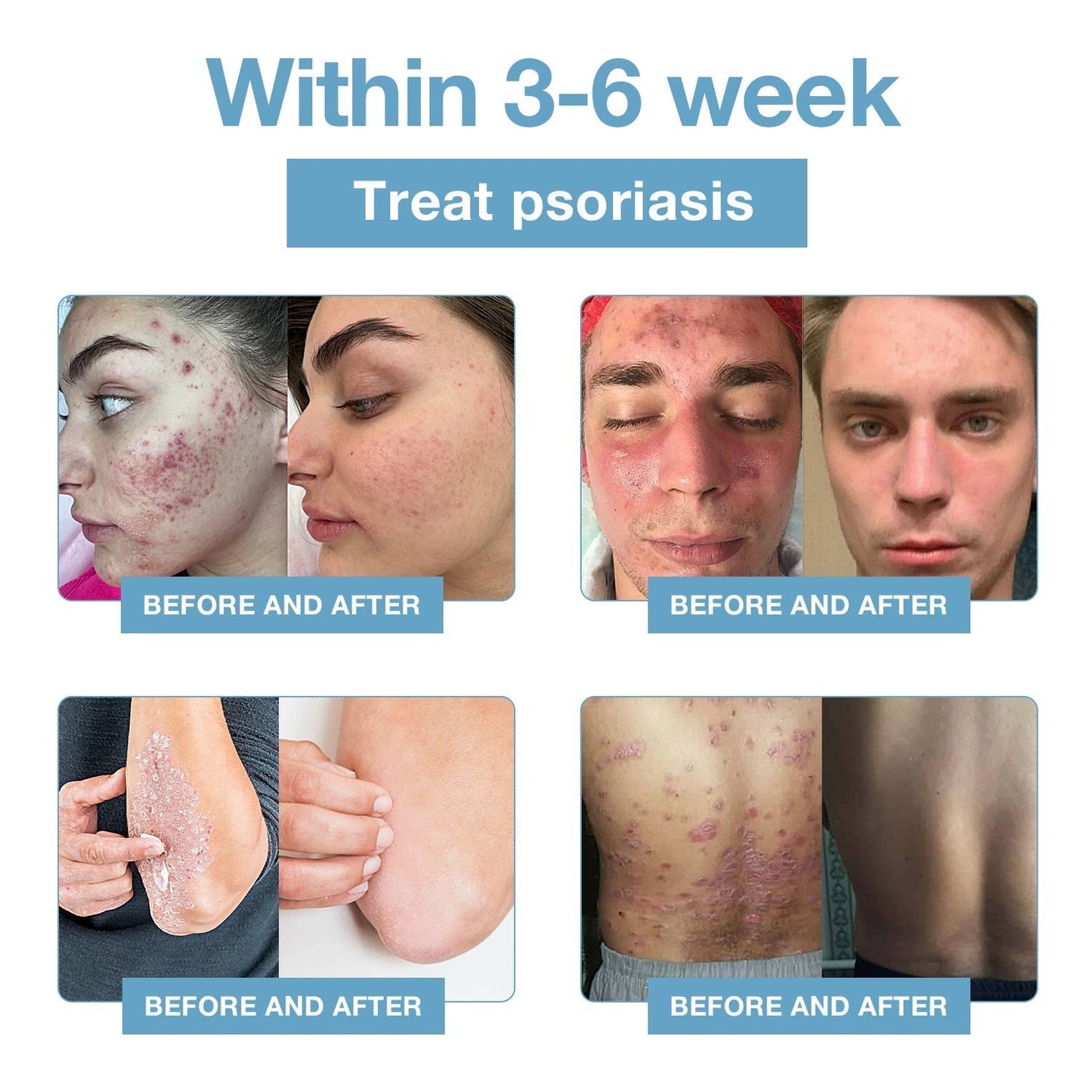 🌞Bee Poison & Ocean Natural Eczema Psoriasis Relief Cream (For all skin conditions)