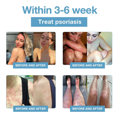 🌞Bee Poison & Ocean Natural Eczema Psoriasis Relief Cream (For all skin conditions)