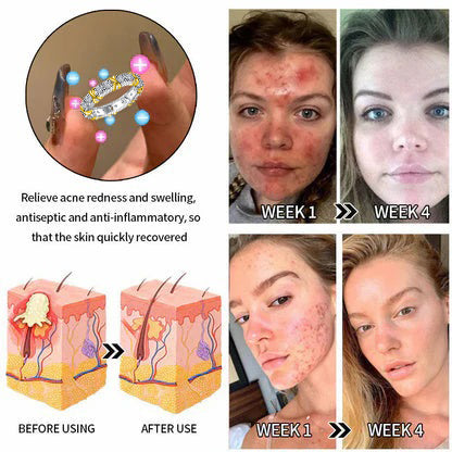 （🔥LAST DAY SALE-80% OFF) DIYSTAR💖Lymphatic magnetic therapy cats eye ring