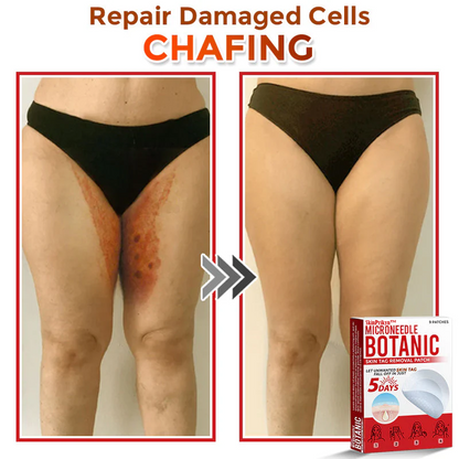 🌈SkinPrikyn™ MicroNeedle Botanic Skin Tag Removal Patch 🇺🇸 Made in the USA
