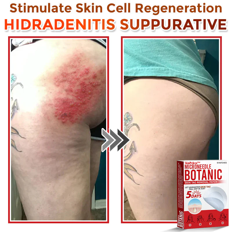 🌈SkinPrikyn™ MicroNeedle Botanic Skin Tag Removal Patch 🇺🇸 Made in the USA