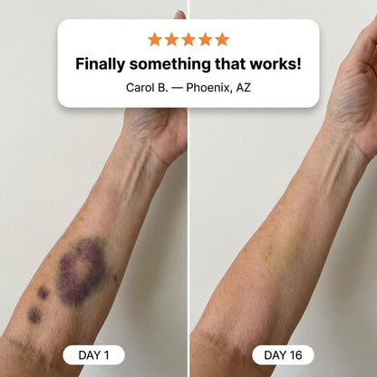 💥100K+ SOLD💕- ZOVVOZ® Bruise Repair & Skin-Strengthening Cream